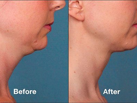 Eliminating the Double Chin